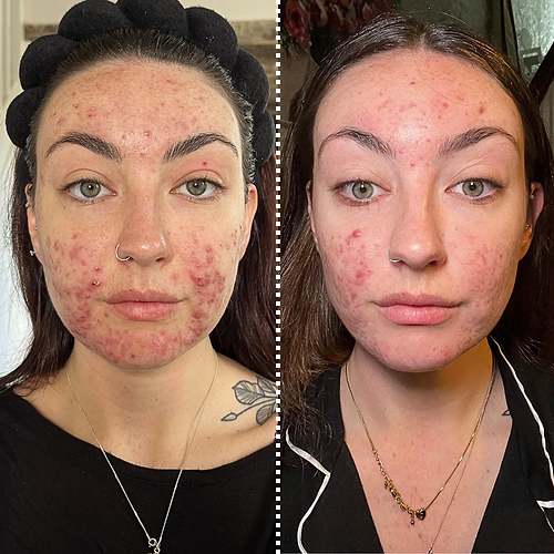 Before and after – calmer skin