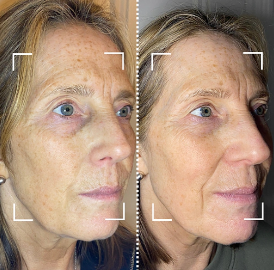 Before and after – even skin tone