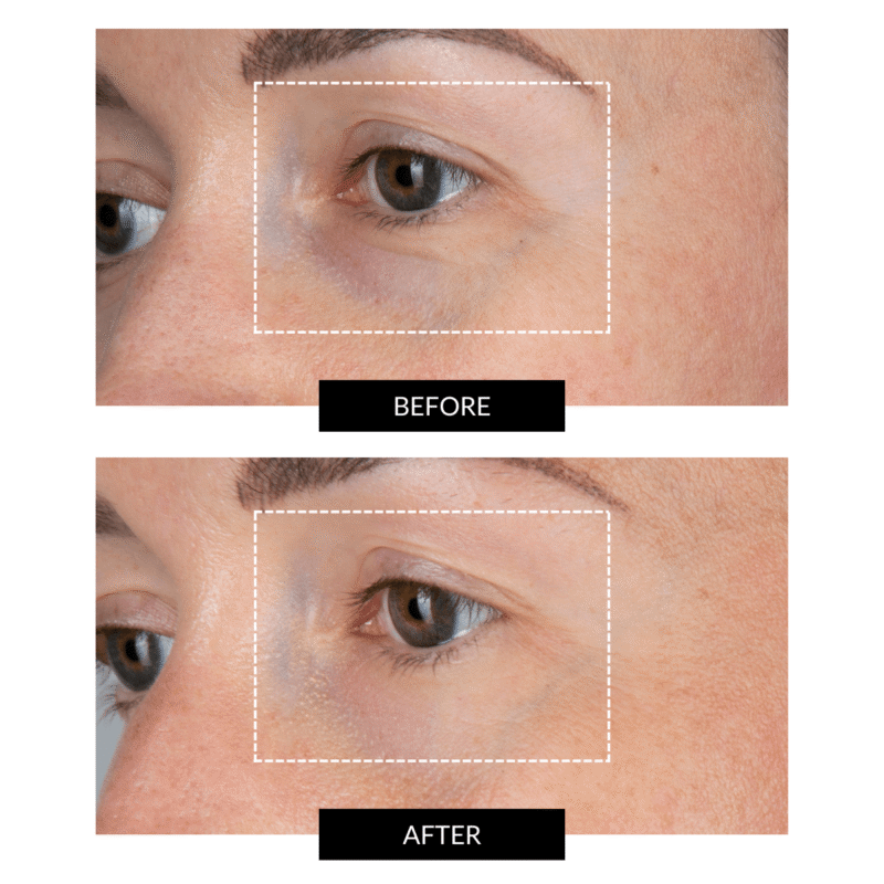 CurrentBody Skin LED Eye Perfector & 5 Eye Hydrogel Masks (worth £224) - Image 3