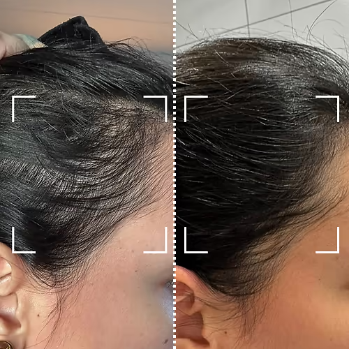 Before and after – thicker hairline